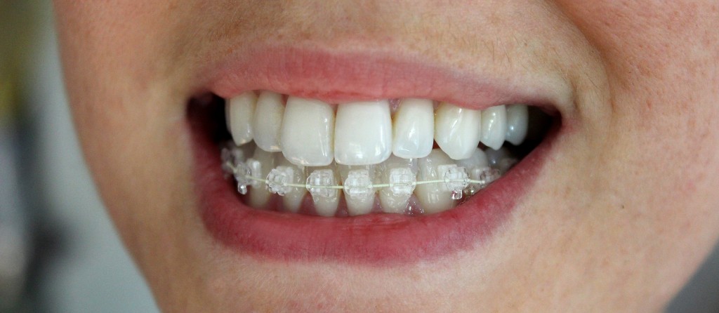 Lower braces